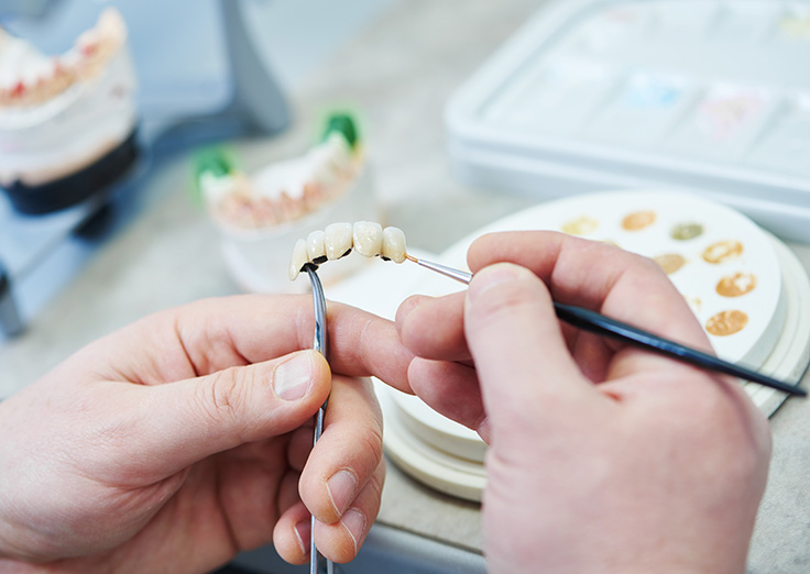 Die perfekte Zahnfarbenanpassung ist eine hohe Kunst